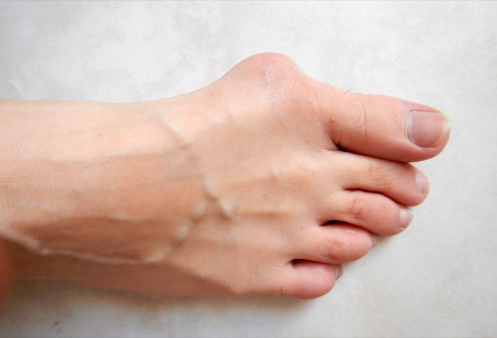 Bunion correction